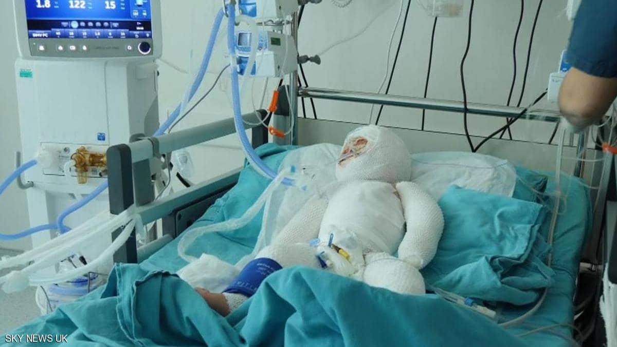 طفلة سورية تفطر القلوب.. نزحت 7 مرات ثم احترقت في مخيم
