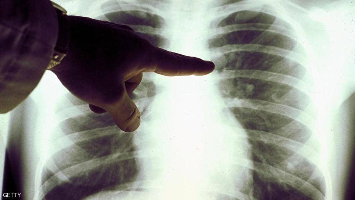لقاح كورونا ومرضى سرطان الثدي.. "علامة" تقلق النساء
