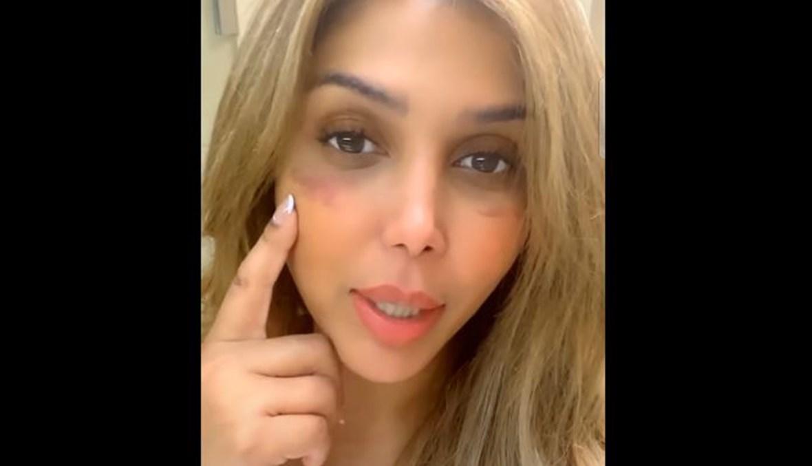 آروى اليمنية بوجه متوّرم تهدّد زوجها: "ضربني بوكس"