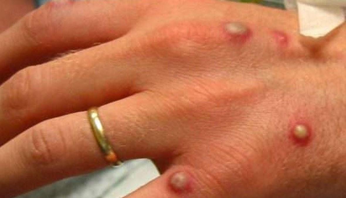تسجيل إصابات بجدري القردة في إسبانيا والبرتغال وبريطانيا... ما هو هذا المرض؟
