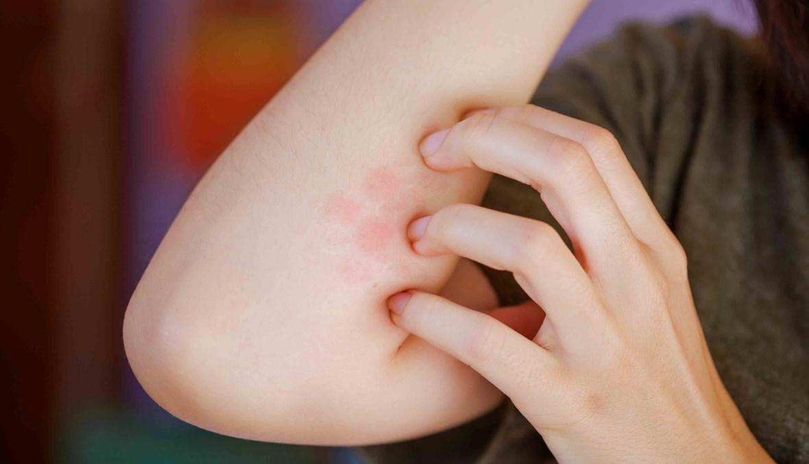 هذه السلوكيات تساعد على ضبط حالة الإكزيما