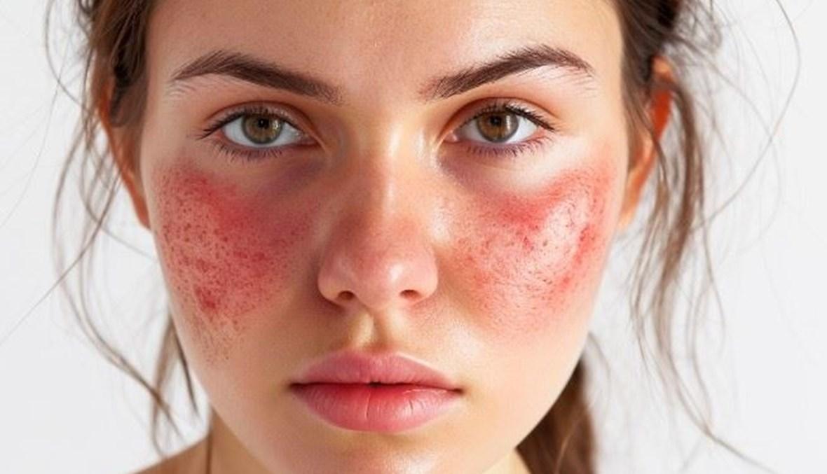 في اليوم العالمي للتّوعية حول داء الذّئبة... من مِن المشاهير مصاب بالمرض؟