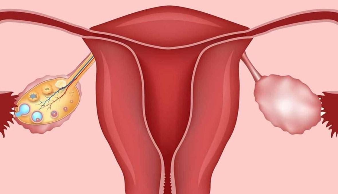متلازمة تكيس المبيض... معاناة كبيرة لنساء كثيرات