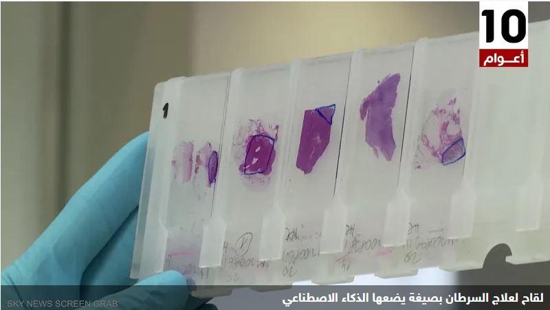 لقاح روسي للسرطان سيكون شخصيا بصيغة يضعها الذكاء الاصطناعي