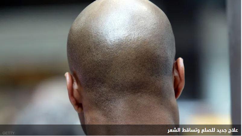 بالصدفة.. اكتشاف علاج ثوري للصلع والسر في السكر