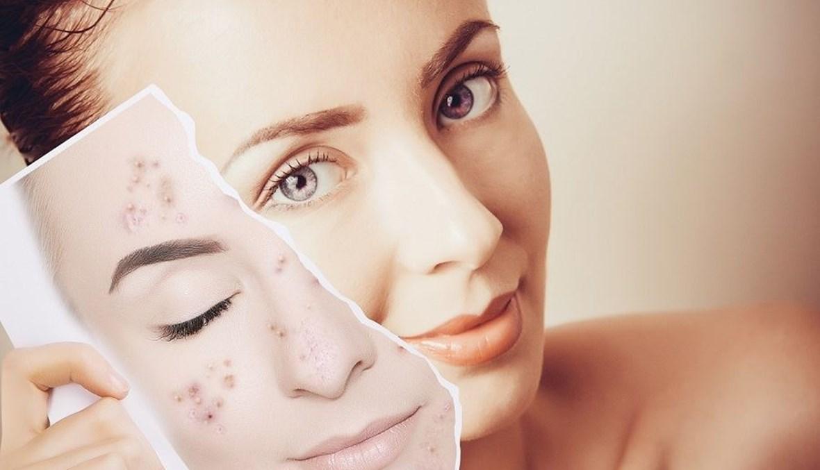 10 نصائح لبشرة بلا عيوب