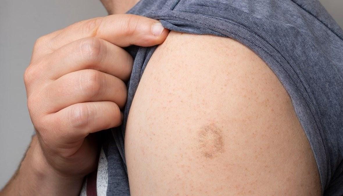 منظمة الصحة تعلن جدري القردة طارئة صحية عالمية