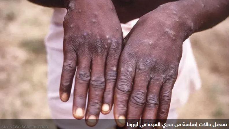 إفريقيا تسجل أكثر من 18700 حالة جدري قردة محتملة في 2024
