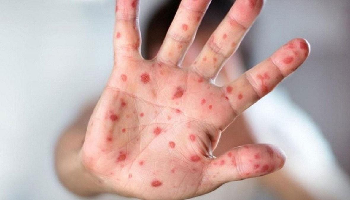 توصيات الصحة حول جدري القردة... هل سُجّلت حالات جديدة في لبنان؟