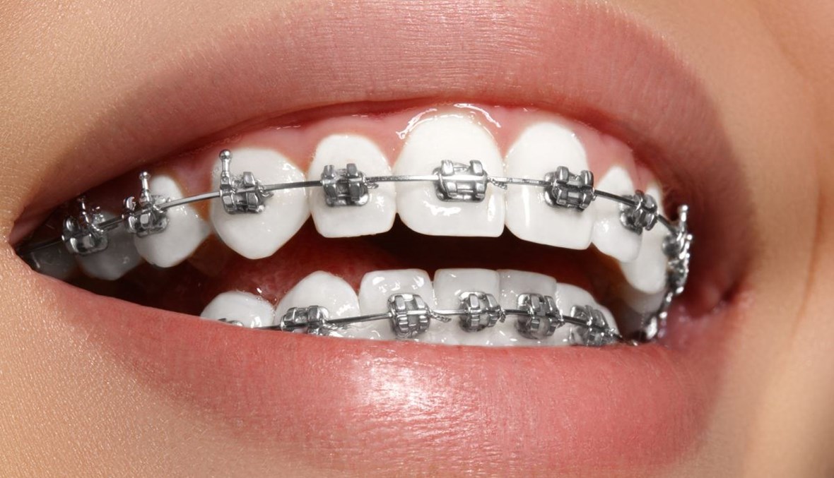 تقويم الأسنان للراشدين... تفاصيل يجب أن تعرفوها