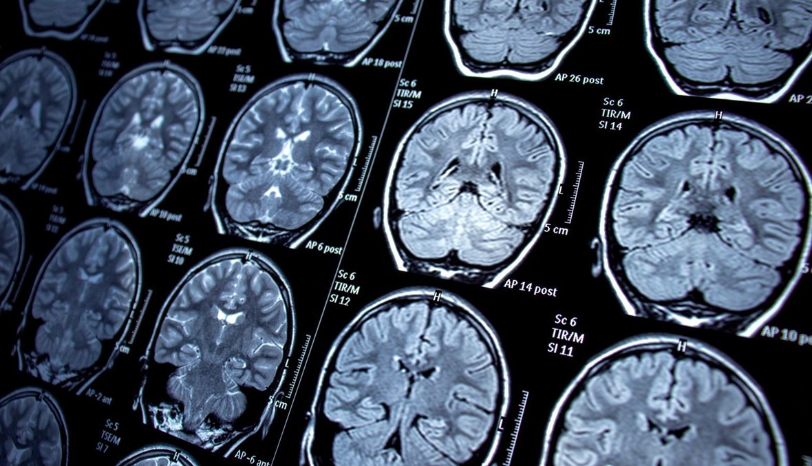 دراسة جديدة تكشف سبب "ضباب الدماغ" بعد الإصابة بفيروس كورونا