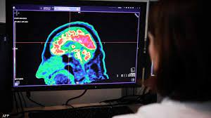 دراسة تكشف حقيقة تأثير "متلازمة هافانا" على المخ